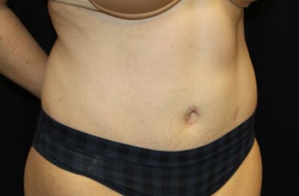 Liposuction Before & After Patient #28240