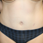 Liposuction Before & After Patient #28240