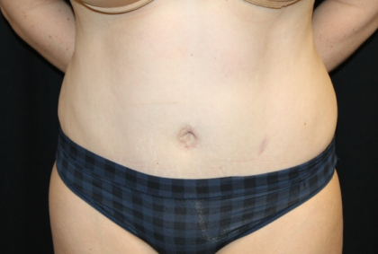 Liposuction Before & After Patient #28240