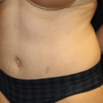 Liposuction Before & After Patient #28240