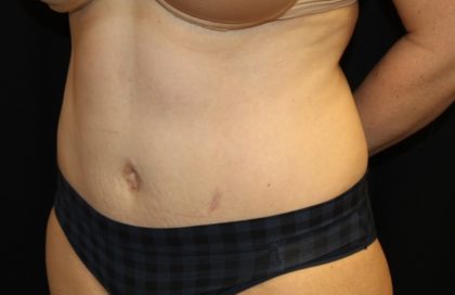 Liposuction Before & After Patient #28240