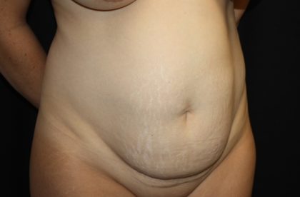 Liposuction Before & After Patient #28240