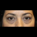 Blepharoplasty Before & After Patient #28362