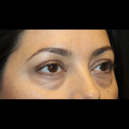 Blepharoplasty Before & After Patient #28362