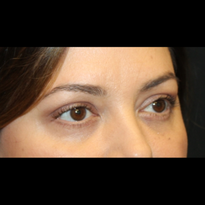 Blepharoplasty Before & After Patient #28362