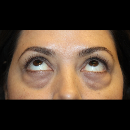 Blepharoplasty Before & After Patient #28362