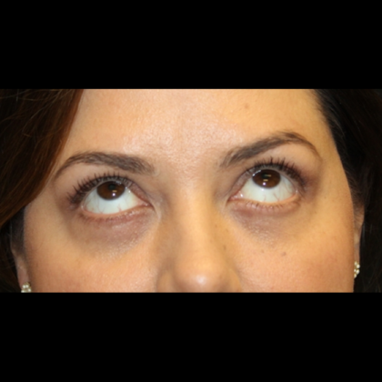 Blepharoplasty Before & After Patient #28362