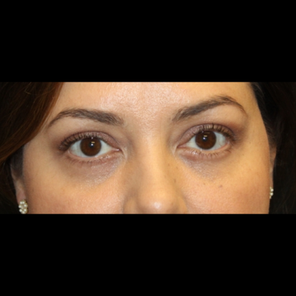 Blepharoplasty Before & After Patient #28362