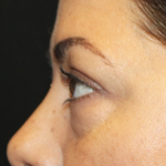 Blepharoplasty Before & After Patient #28362