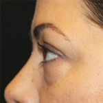 Blepharoplasty Before & After Patient #28362