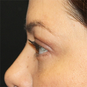 Blepharoplasty Before & After Patient #28362