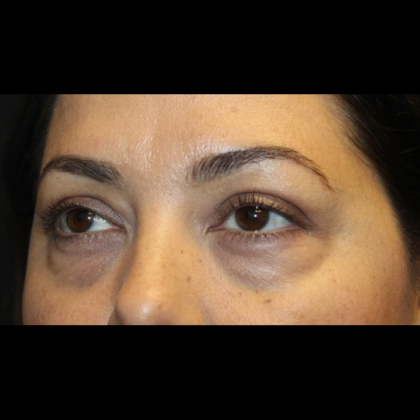 Blepharoplasty Before & After Patient #28362