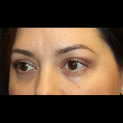 Blepharoplasty Before & After Patient #28362