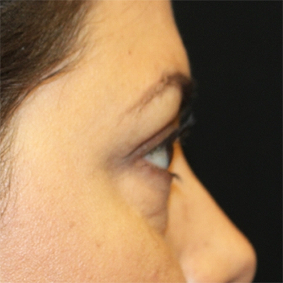 Blepharoplasty Before & After Patient #28362