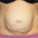 Tummy Tuck Before & After Patient #28452