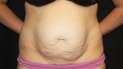 Tummy Tuck Before & After Patient #28452