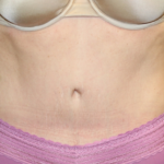 Tummy Tuck Before & After Patient #28452