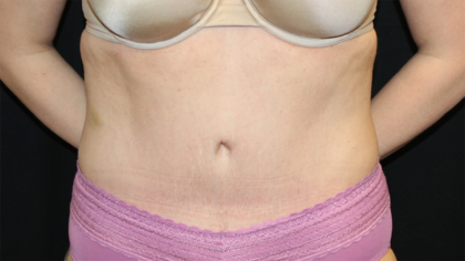 Tummy Tuck Before & After Patient #28452