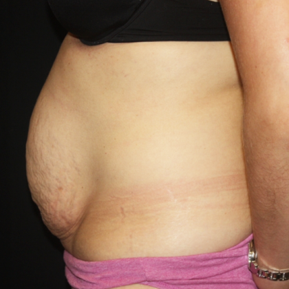 Tummy Tuck Before & After Patient #28452