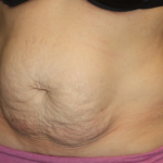 Tummy Tuck Before & After Patient #28452