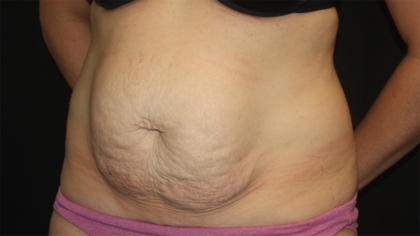 Tummy Tuck Before & After Patient #28452