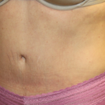 Tummy Tuck Before & After Patient #28452