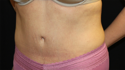 Tummy Tuck Before & After Patient #28452