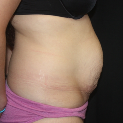 Tummy Tuck Before & After Patient #28452