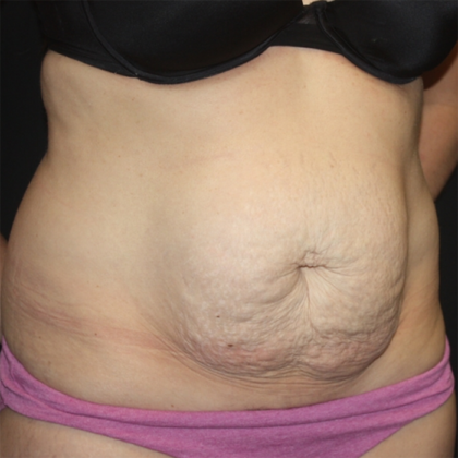 Tummy Tuck Before & After Patient #28452