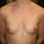 Breast Augmentation - Round Silicone Implants Before & After Patient #28392