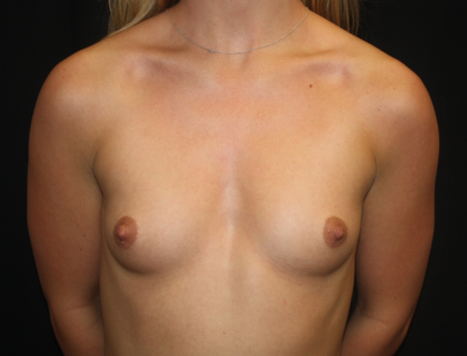 Breast Augmentation - Round Silicone Implants Before & After Patient #28392
