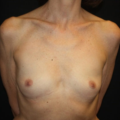 Breast Augmentation Before & After Patient #28485