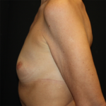 Breast Augmentation Before & After Patient #28485