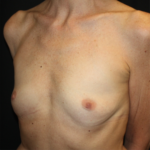 Breast Augmentation Before & After Patient #28485