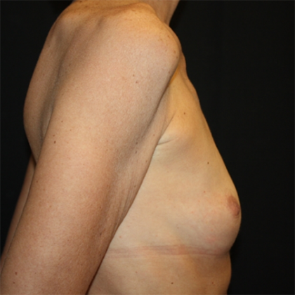 Breast Augmentation Before & After Patient #28485