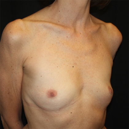 Breast Augmentation Before & After Patient #28485