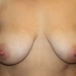 Breast Lift Before & After Patient #28474