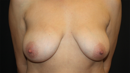 Breast Lift Before & After Patient #28474