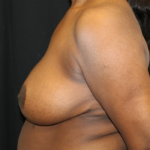 Breast Reduction Before & After Patient #28463