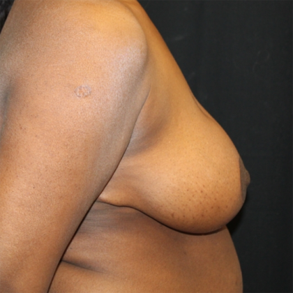 Breast Reduction Before & After Patient #28463