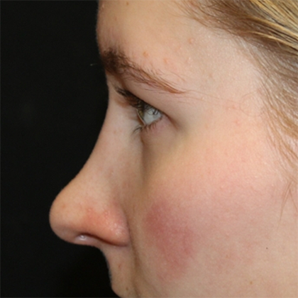 Rhinoplasty Before & After Patient #28428