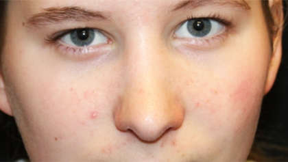 Rhinoplasty Before & After Patient #28428