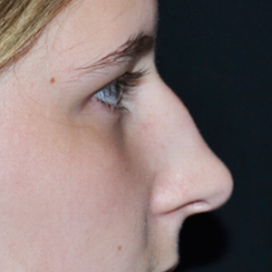 Rhinoplasty Before & After Patient #28428