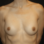 Breast Implant Exchange Before & After Patient #28815