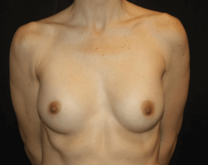 Breast Implant Exchange Before & After Patient #28815