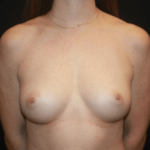 Breast Augmentation - Round Silicone Implants Before & After Patient #28804