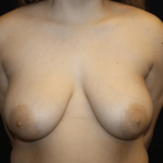 Breast Reduction Before & After Patient #28835
