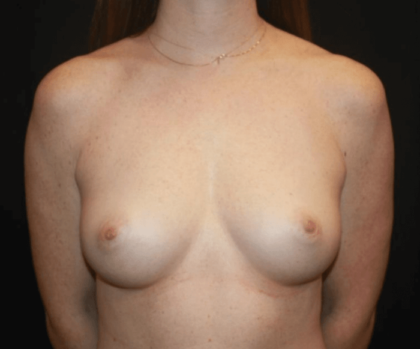 Breast Augmentation - Round Silicone Implants Before & After Patient #28804