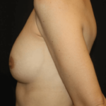 Breast Implant Exchange Before & After Patient #28815