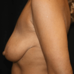 Breast Lift with Implant Before & After Patient #28826